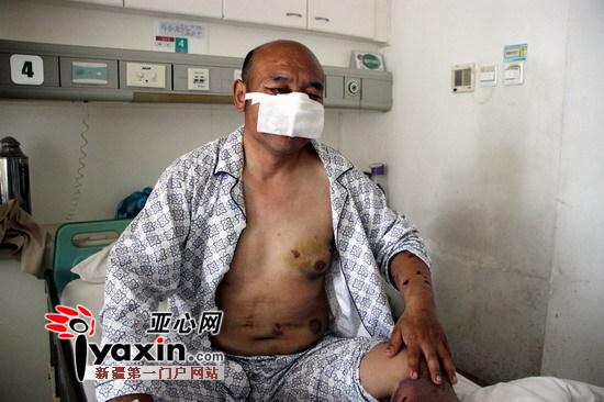 新疆沙灣村民山中撿玉遭棕熊攻擊 鼻子、上嘴唇被咬掉撿回一命（圖）