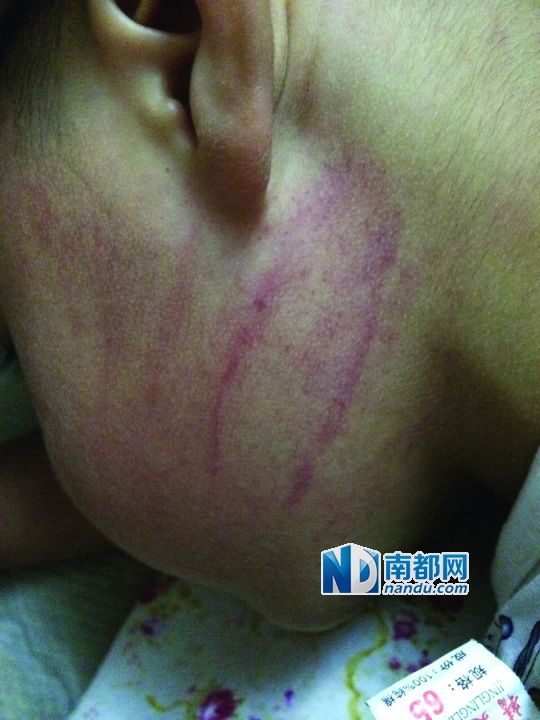 小逸臉上淤痕清晰可見(jiàn)。