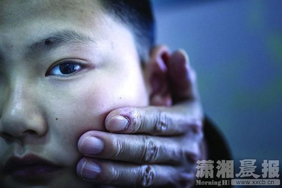 1月13日，小玨的父親心疼地摸著兒子的臉。