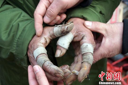 圖為由于常年拾荒，老人雙手布滿傷口。周小云 攝